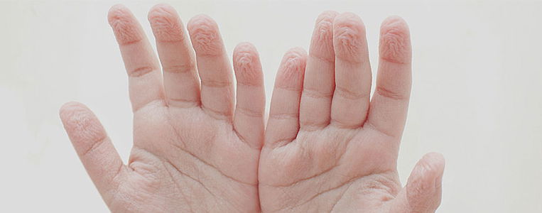 Warum.Darum.schrumpeligeHande